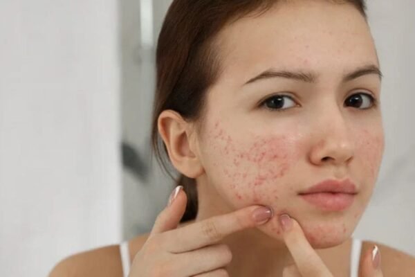 Compulsive Skin Picking