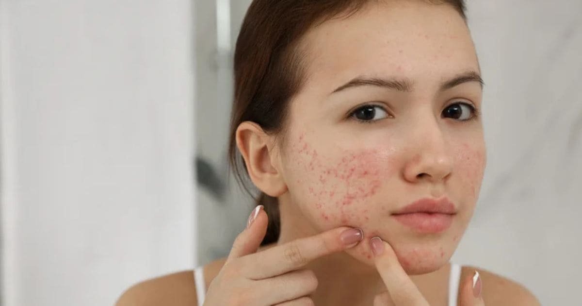 Compulsive Skin Picking